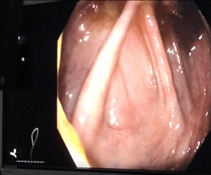 Cecum picture