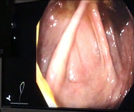 Cecum picture