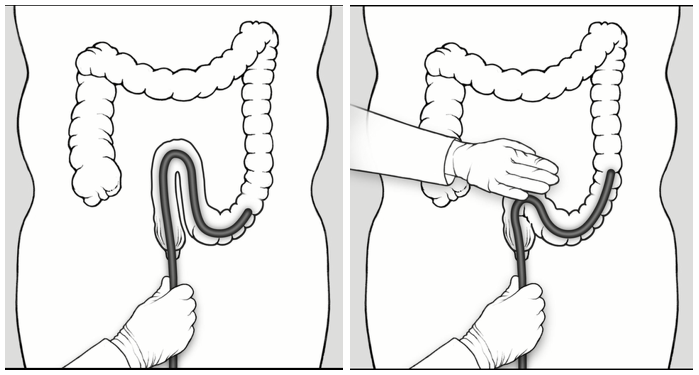 Looping in colon, looping mitigated with abdominal pressure