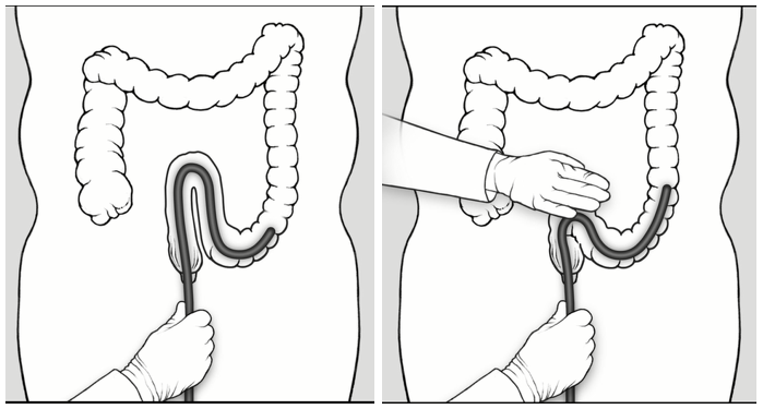 Looping in Colonoscopy: A Video on the What, Why, & How