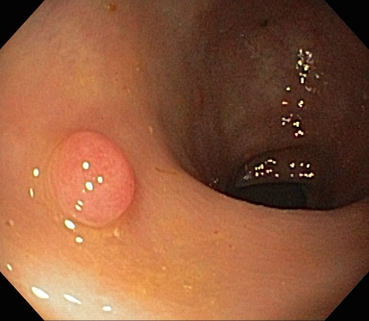 Colonoscopy Quality Measures: Withdrawal Time & ADR